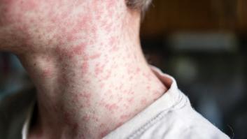 Las autoridades sanitarias españolas activan las alertas por la enfermedad contagiosa que llega desde Marruecos